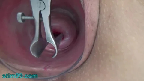 Saf – Presents Open cervix speculum semen insertion in uterus
